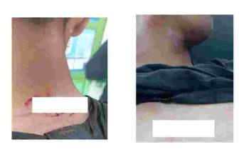 Cekcok Mulut, Leher – Dada Warga Lubuk Raja  Kena Sabetan Sajam