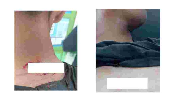 Cekcok Mulut, Leher – Dada Warga Lubuk Raja  Kena Sabetan Sajam